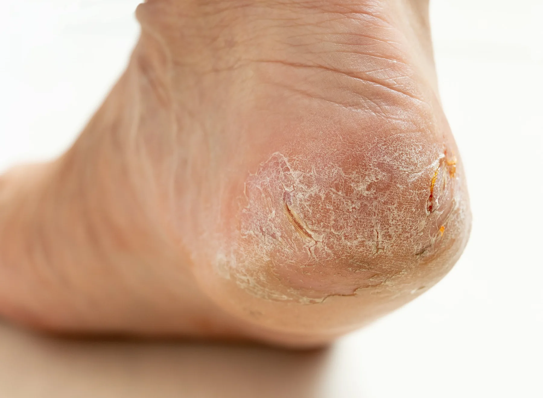 A podiatrist treating a patient's cracked heel in the clinic